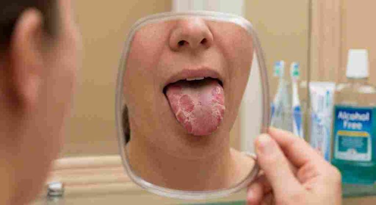 What is a geographic tongue