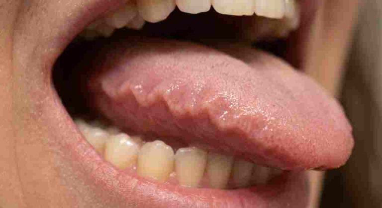 scalloped tongue